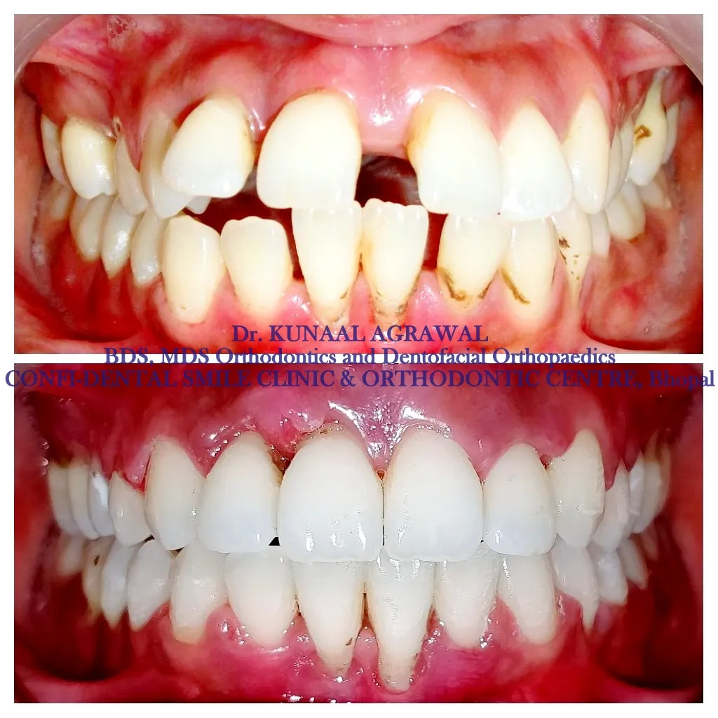braces before and after bhopal 14